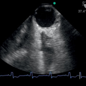critical care transesophageal echocardiography