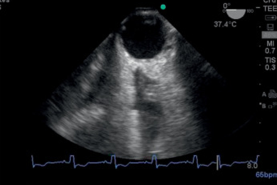 critical care transesophageal echocardiography